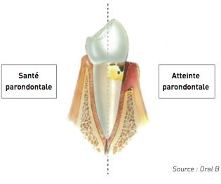 parodontite.001